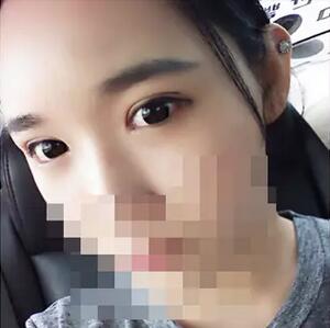 埋线双眼皮恢复