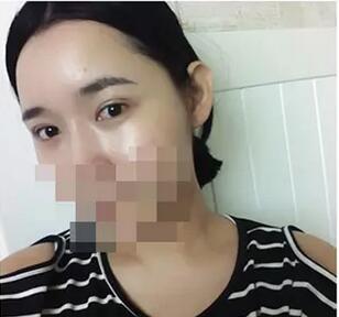 埋线双眼皮恢复过程