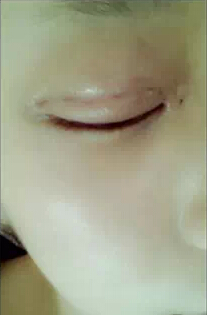 埋线双眼皮多久能恢复？