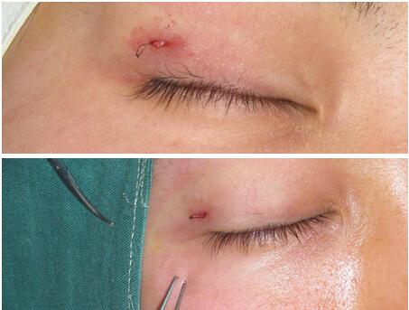 埋线双眼皮拆线