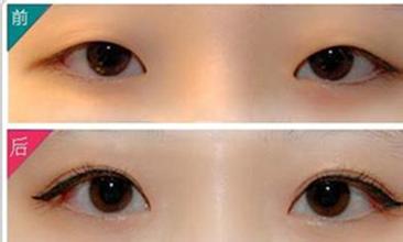 埋线双眼皮
