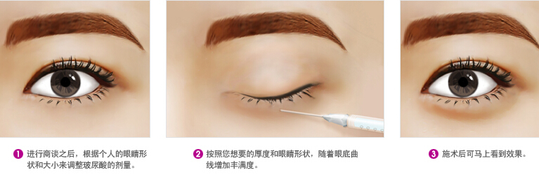 玻尿酸丰卧蚕为例