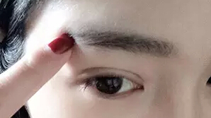 多图告诉你：埋线双眼皮多久能恢复？