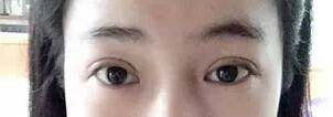 有图有真相 看网友晒埋线双眼皮恢复过程