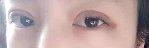 有图有真相 看网友晒埋线双眼皮恢复过程