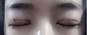 有图有真相 看网友晒埋线双眼皮恢复过程