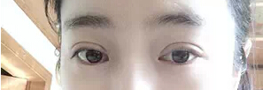 有图有真相 看网友晒埋线双眼皮恢复过程