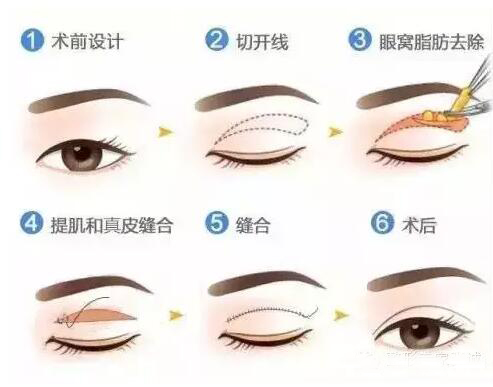 整形双眼皮