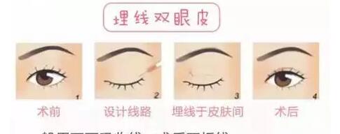 韩式双眼皮怎么做
