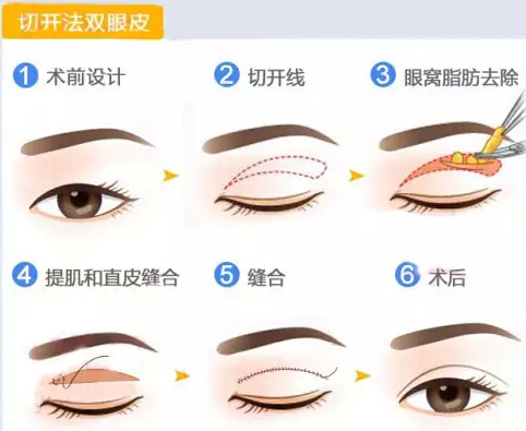 埋线双眼皮——不开刀的双眼皮！