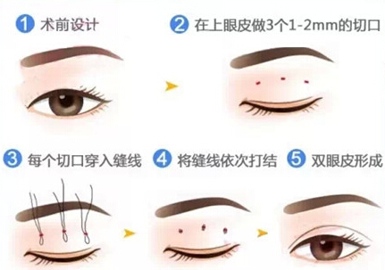 开眼角和双眼皮有什么关系？“邻居”而已！