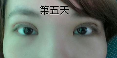 95后萌妹纸:终于等到你我的埋线双眼皮!