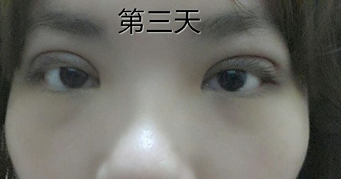 95后萌妹纸:终于等到你我的埋线双眼皮!