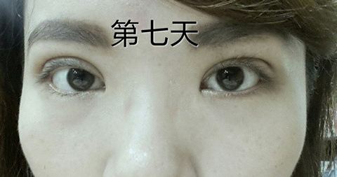 95后萌妹纸:终于等到你我的埋线双眼皮!