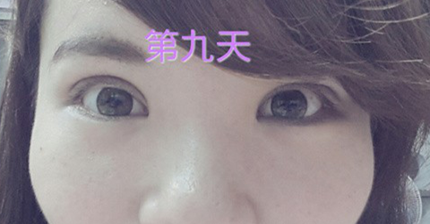 埋线双眼皮