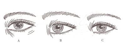 割双眼皮开眼角