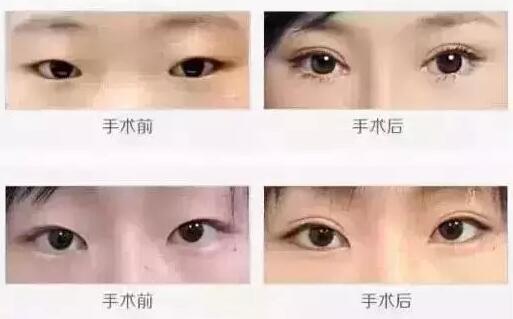 割双眼皮开眼角
