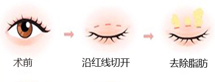 干货分享：韩式双眼皮手术有哪些？
