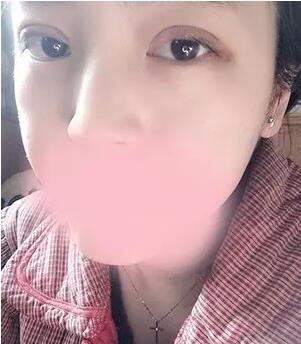埋线双眼皮图片 真人案例讲解恢复过程