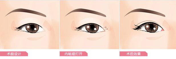 开内眼角后变化大吗?看了就知道
