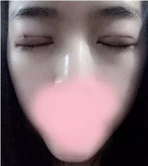 埋线双眼皮图片 真人案例讲解恢复过程