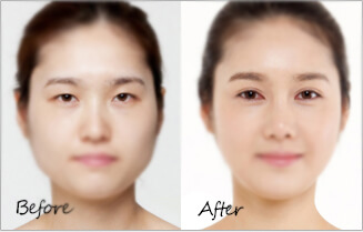 开内眼角手术前后对比图