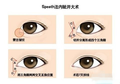 开内眼角有几种方法？答案在这里