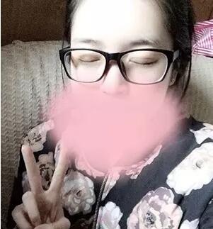 埋线双眼皮图片 真人案例讲解恢复过程