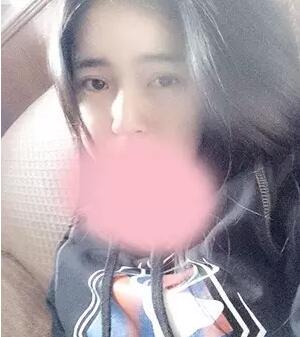 埋线双眼皮图片 对比介绍恢复过程