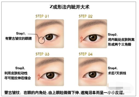 开内眼角有几种方法？答案在这里