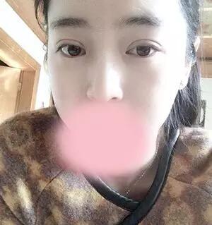 埋线双眼皮图片 真人案例讲解恢复过程