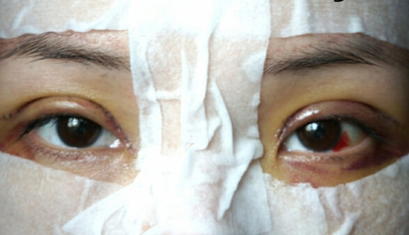 讲述：我做切开双眼皮术后消肿超快！