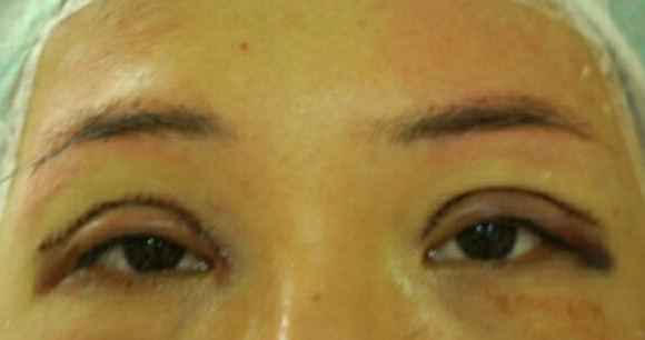 讲述：我做切开双眼皮术后消肿超快！