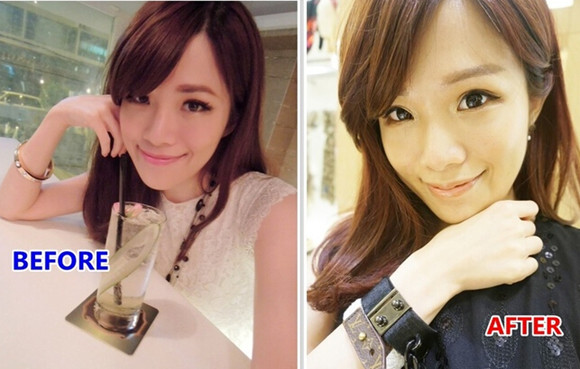 讲述：我做切开双眼皮术后消肿超快！