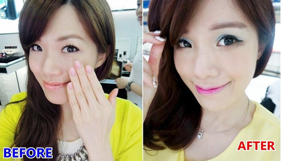 讲述：我做切开双眼皮术后消肿超快！