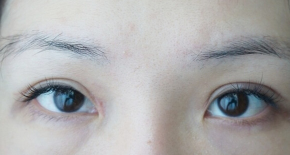 切开双眼皮术后第20天