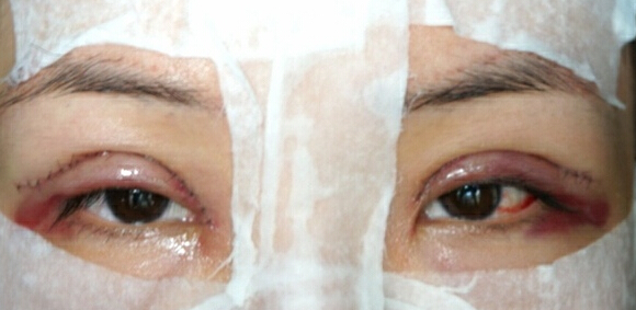 讲述：我做切开双眼皮术后消肿超快！