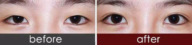双眼皮消失修复