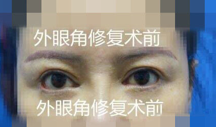 外眼角修复