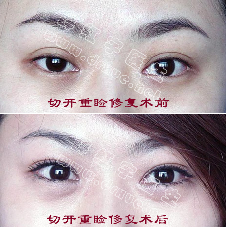 双眼皮修复