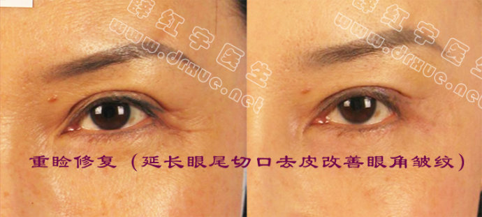 双眼皮修复