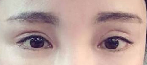 不对称双眼皮失败手术案例