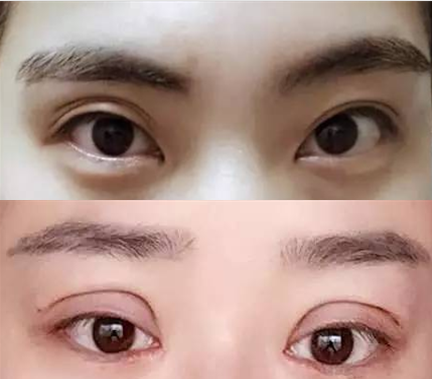 双眼皮过宽或形成三眼皮失败案例