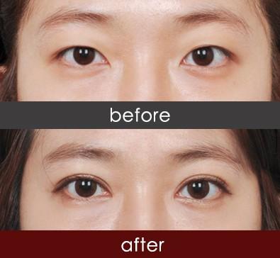 如何选择双眼皮修复方法
