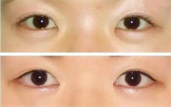开眼角的适应症都有哪些,开眼角手术,开内眼角,双眼皮手术
