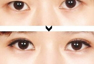 韩式双眼皮手术的优点