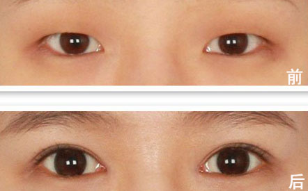 韩式双眼皮手术的安全性