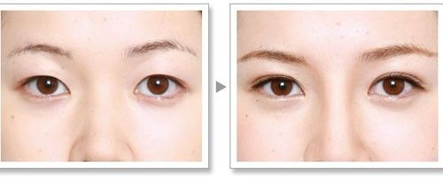 韩式双眼皮手术后的副作用,双眼皮的副作用,割双眼皮的坏处