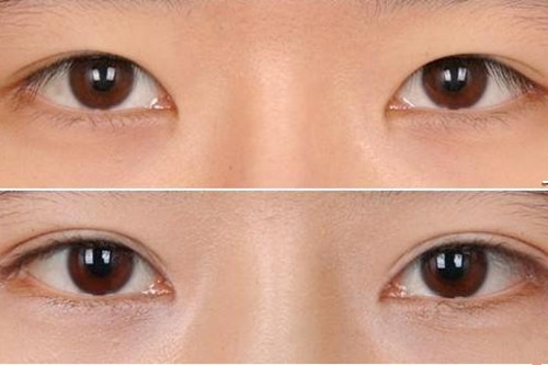 韩式双眼皮的后遗症表现
