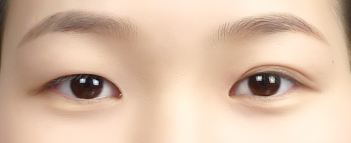 韩式双眼皮手术后的维持时间,埋线双眼皮